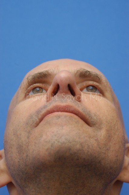 Fat Injection Face Before and After | Sayah Institute