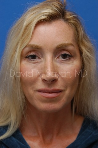 Fat Injection Face Before and After | Sayah Institute