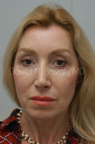 Fat Injection Face Before and After | Sayah Institute