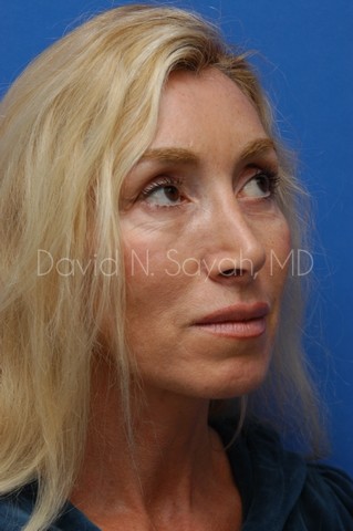 Fat Injection Face Before and After | Sayah Institute