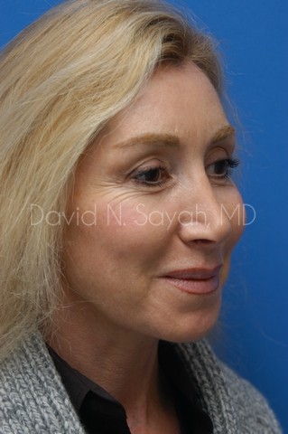 Fat Injection Face Before and After | Sayah Institute