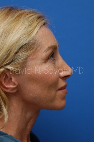 Fat Injection Face Before and After | Sayah Institute