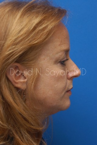 Fat Injection Face Before and After | Sayah Institute