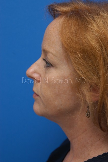 Fat Injection Face Before and After | Sayah Institute