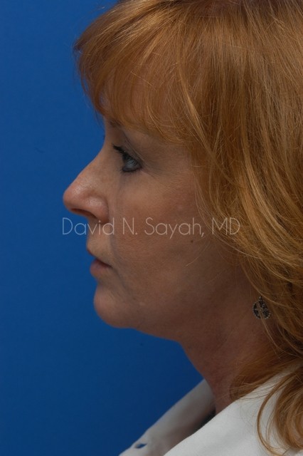 Fat Injection Face Before and After | Sayah Institute