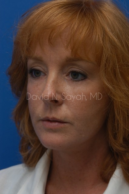 Fat Injection Face Before and After | Sayah Institute