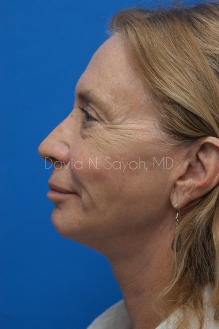 Fat Injection Face Before and After | Sayah Institute