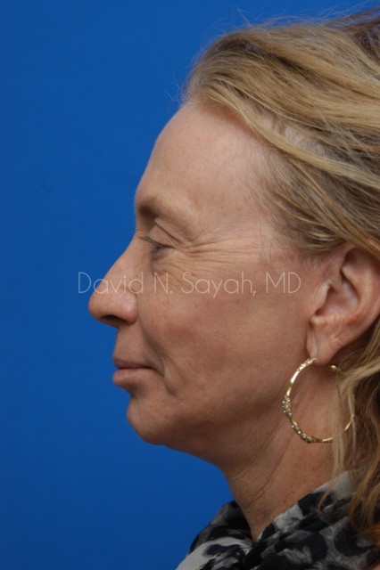 Fat Injection Face Before and After | Sayah Institute