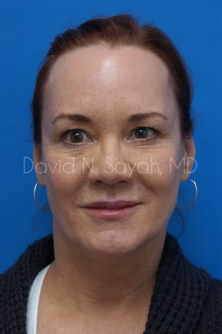 Fat Injection Face Before and After | Sayah Institute