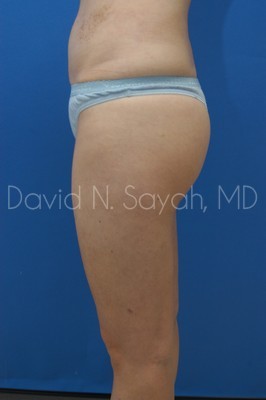 Gluteal Augmentation Before and After | Sayah Institute