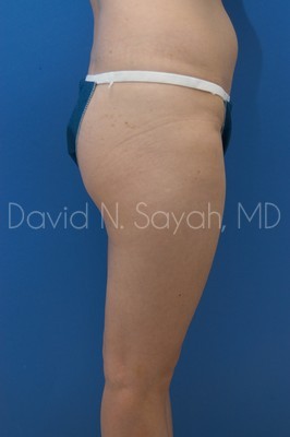 Gluteal Augmentation Before and After | Sayah Institute