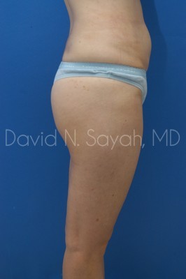 Gluteal Augmentation Before and After | Sayah Institute