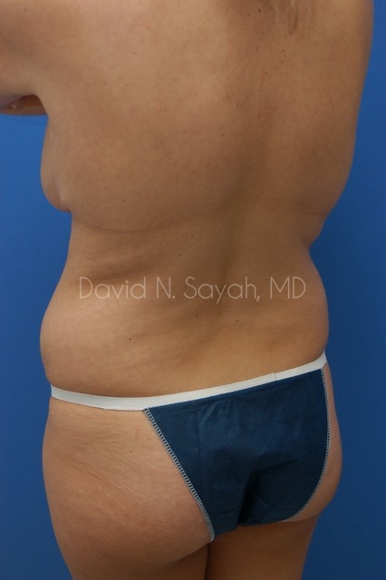 Gluteal Augmentation Before and After | Sayah Institute