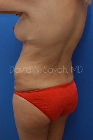 Gluteal Augmentation Before and After | Sayah Institute