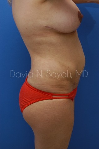 Gluteal Augmentation Before and After | Sayah Institute