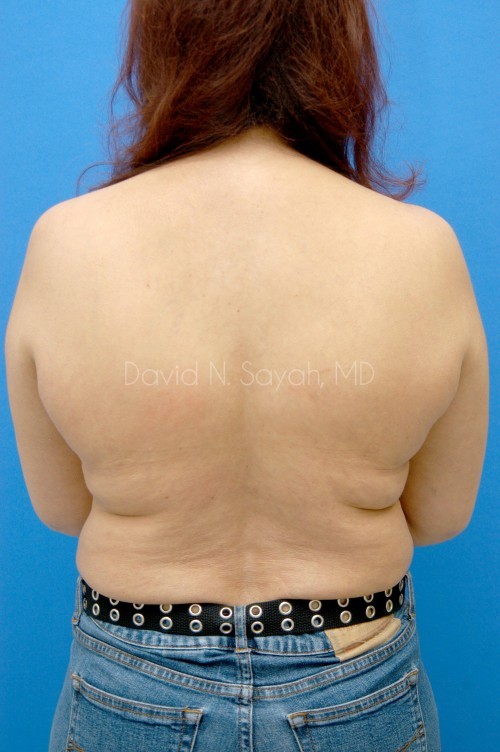 Liposuction Before and After | Sayah Institute