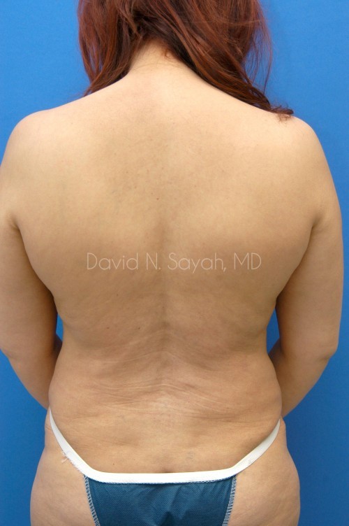 Liposuction Before and After | Sayah Institute