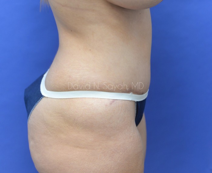 Liposuction Before and After | Sayah Institute