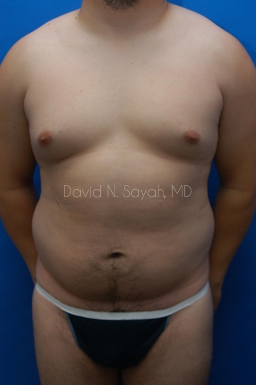 Liposuction Before and After | Sayah Institute