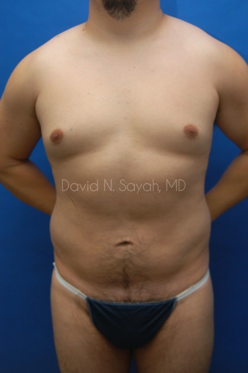 Liposuction Before and After | Sayah Institute