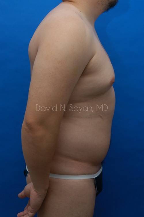 Liposuction Before and After | Sayah Institute