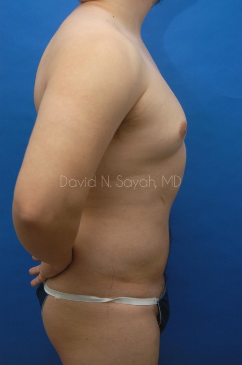 Liposuction Before and After | Sayah Institute