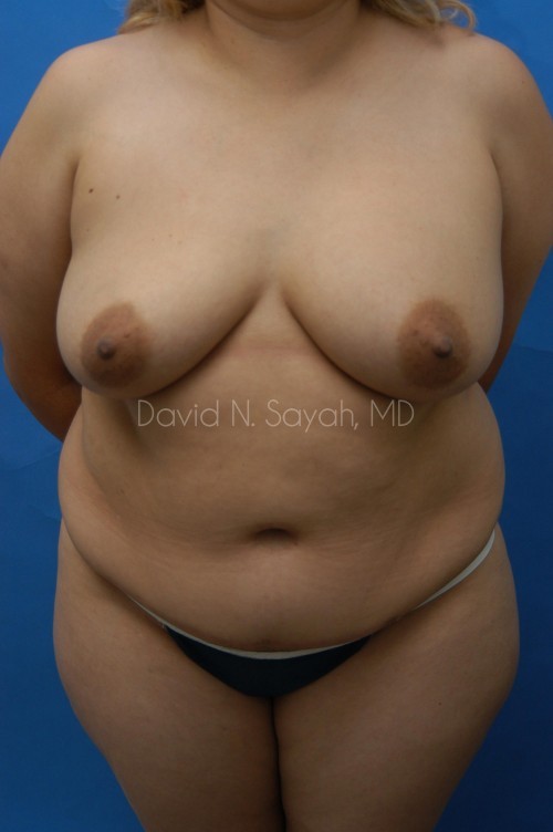 Liposuction Before and After | Sayah Institute