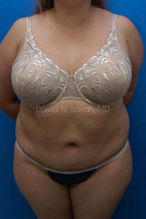 Liposuction Before and After | Sayah Institute