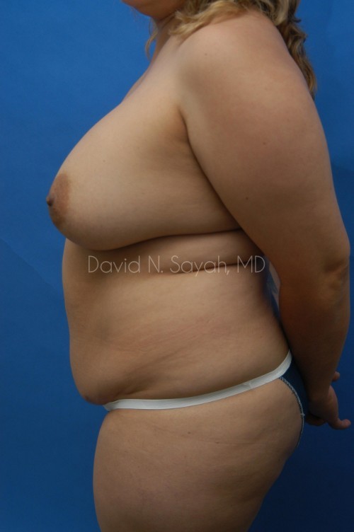 Liposuction Before and After | Sayah Institute