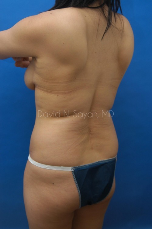 Liposuction Before and After | Sayah Institute