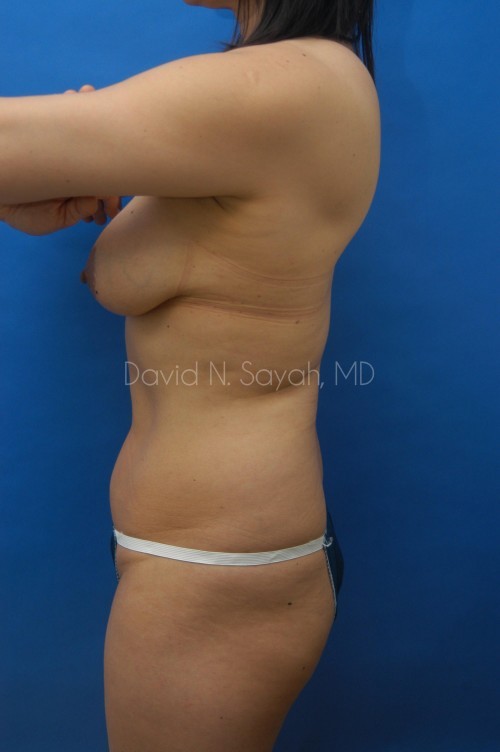 Liposuction Before and After | Sayah Institute