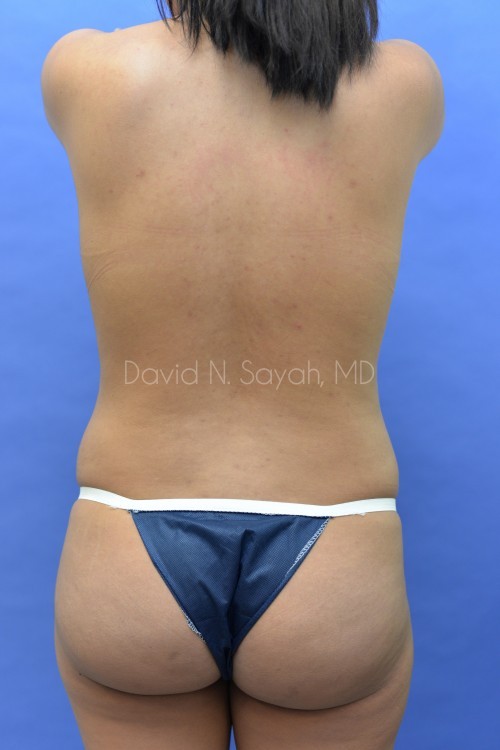 Liposuction Before and After | Sayah Institute