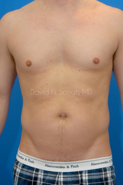 Liposuction Before and After | Sayah Institute