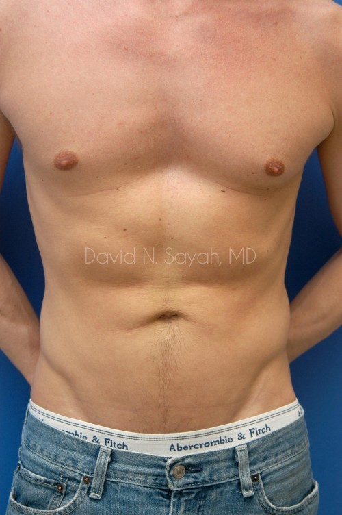 Liposuction Before and After | Sayah Institute