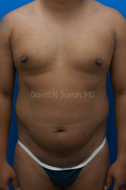 Liposuction Before and After | Sayah Institute