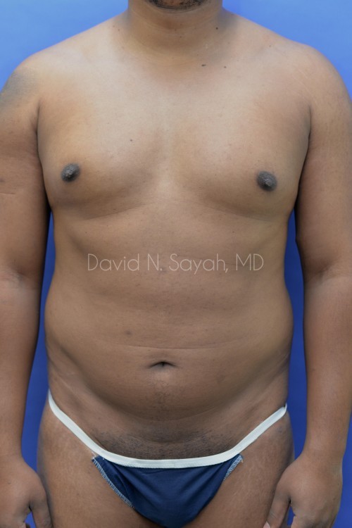 Liposuction Before and After | Sayah Institute