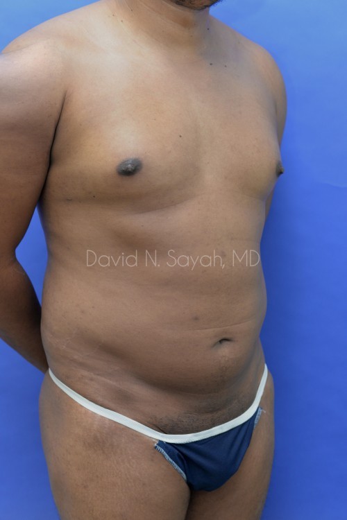 Liposuction Before and After | Sayah Institute