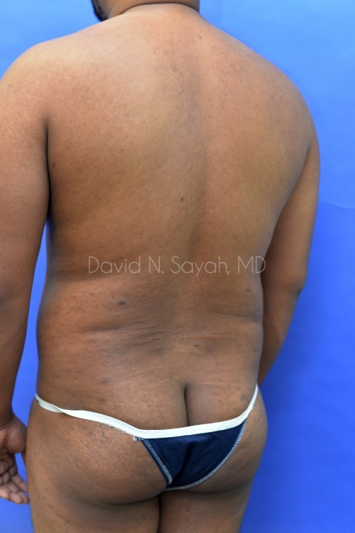 Liposuction Before and After | Sayah Institute
