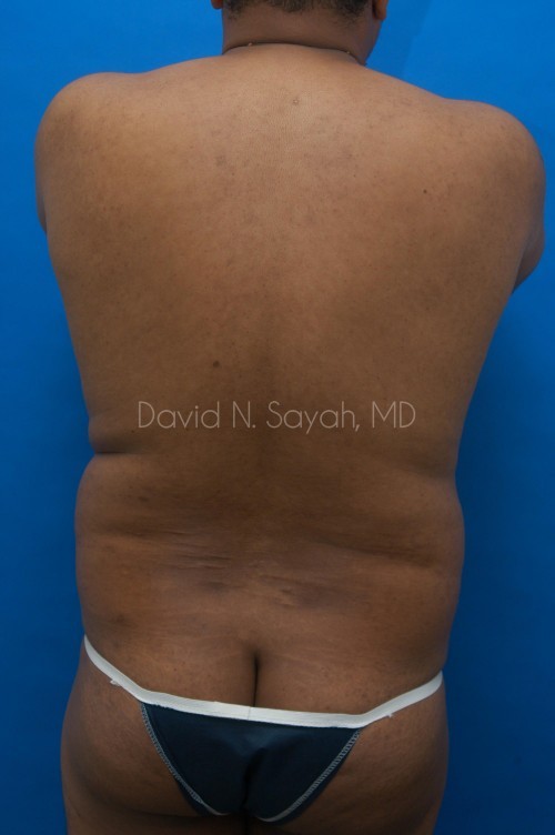 Liposuction Before and After | Sayah Institute