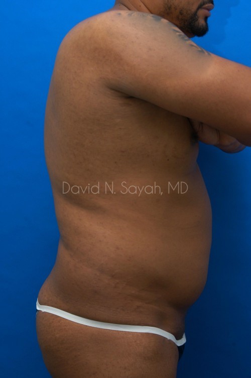 Liposuction Before and After | Sayah Institute