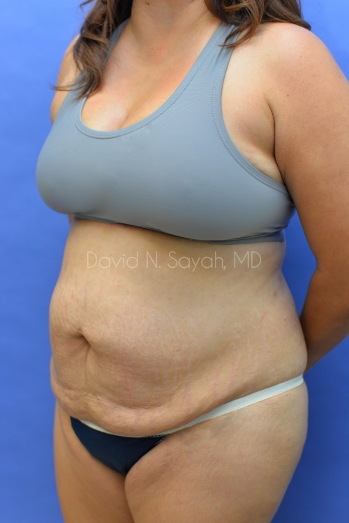 Liposuction Before and After | Sayah Institute