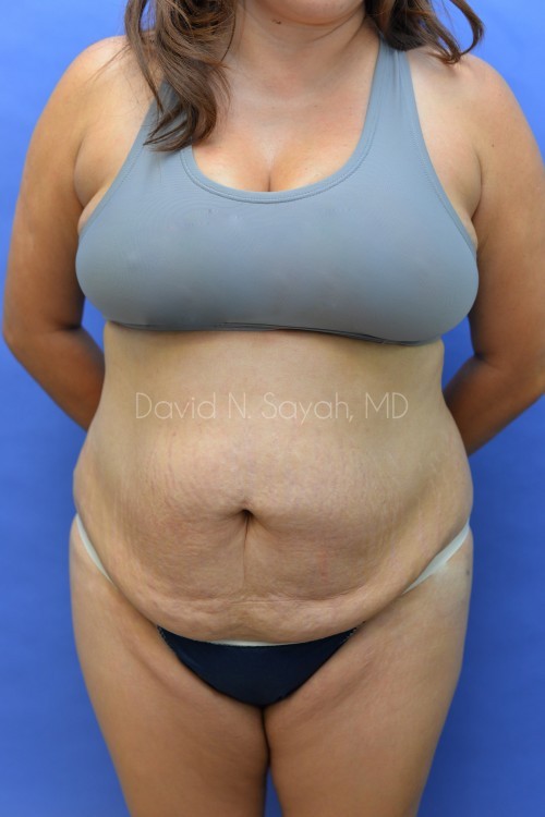Liposuction Before and After | Sayah Institute