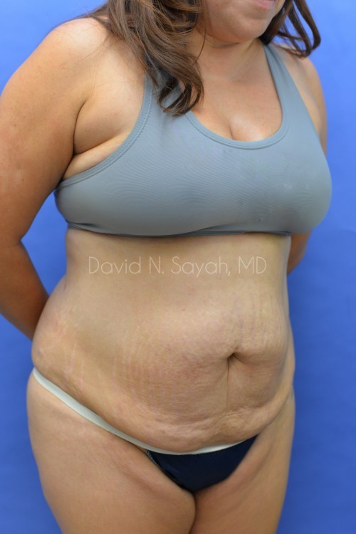 Liposuction Before and After | Sayah Institute