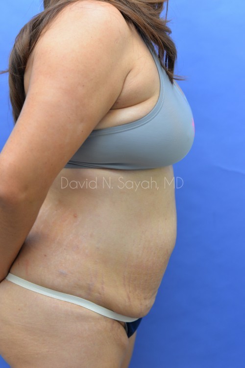 Liposuction Before and After | Sayah Institute