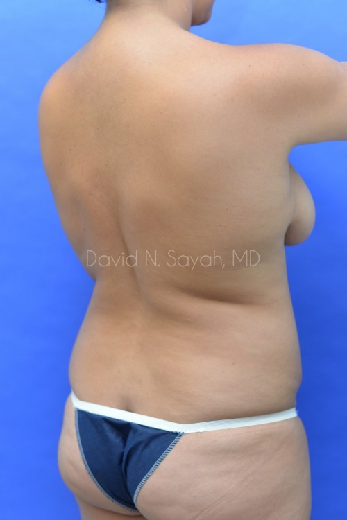 Liposuction Before and After | Sayah Institute