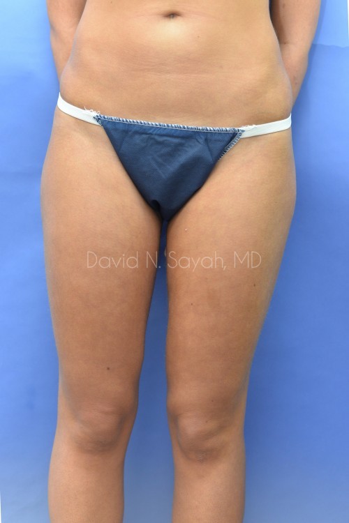 Liposuction Before and After | Sayah Institute