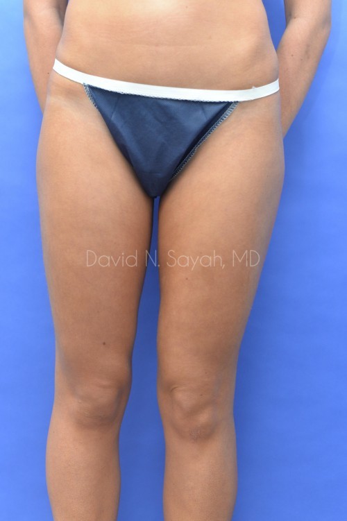 Liposuction Before and After | Sayah Institute