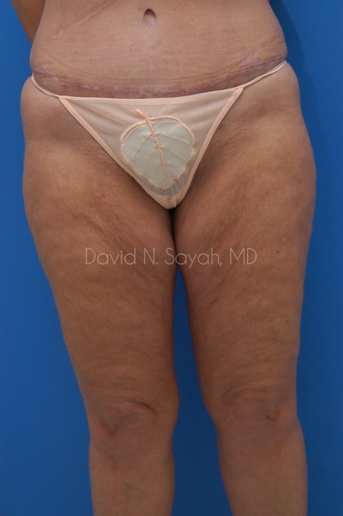 Liposuction Before and After | Sayah Institute