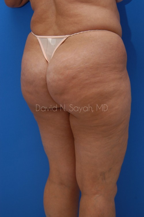 Liposuction Before and After | Sayah Institute