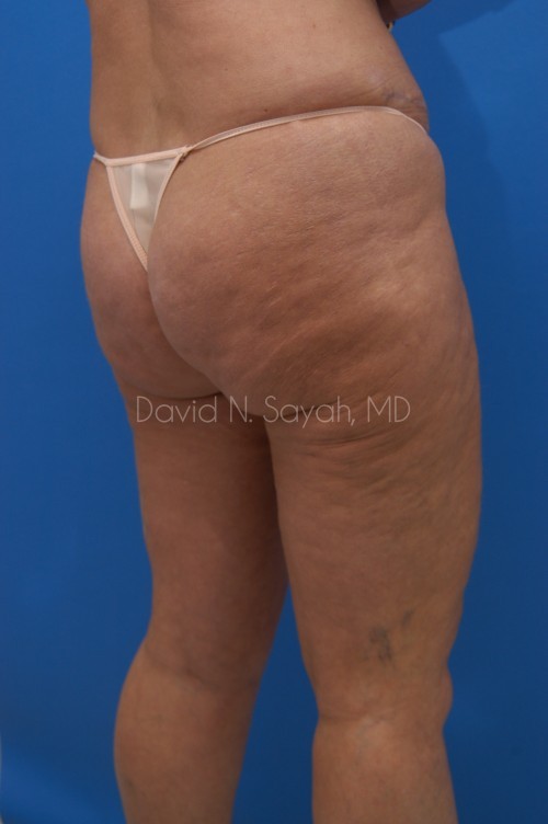 Liposuction Before and After | Sayah Institute